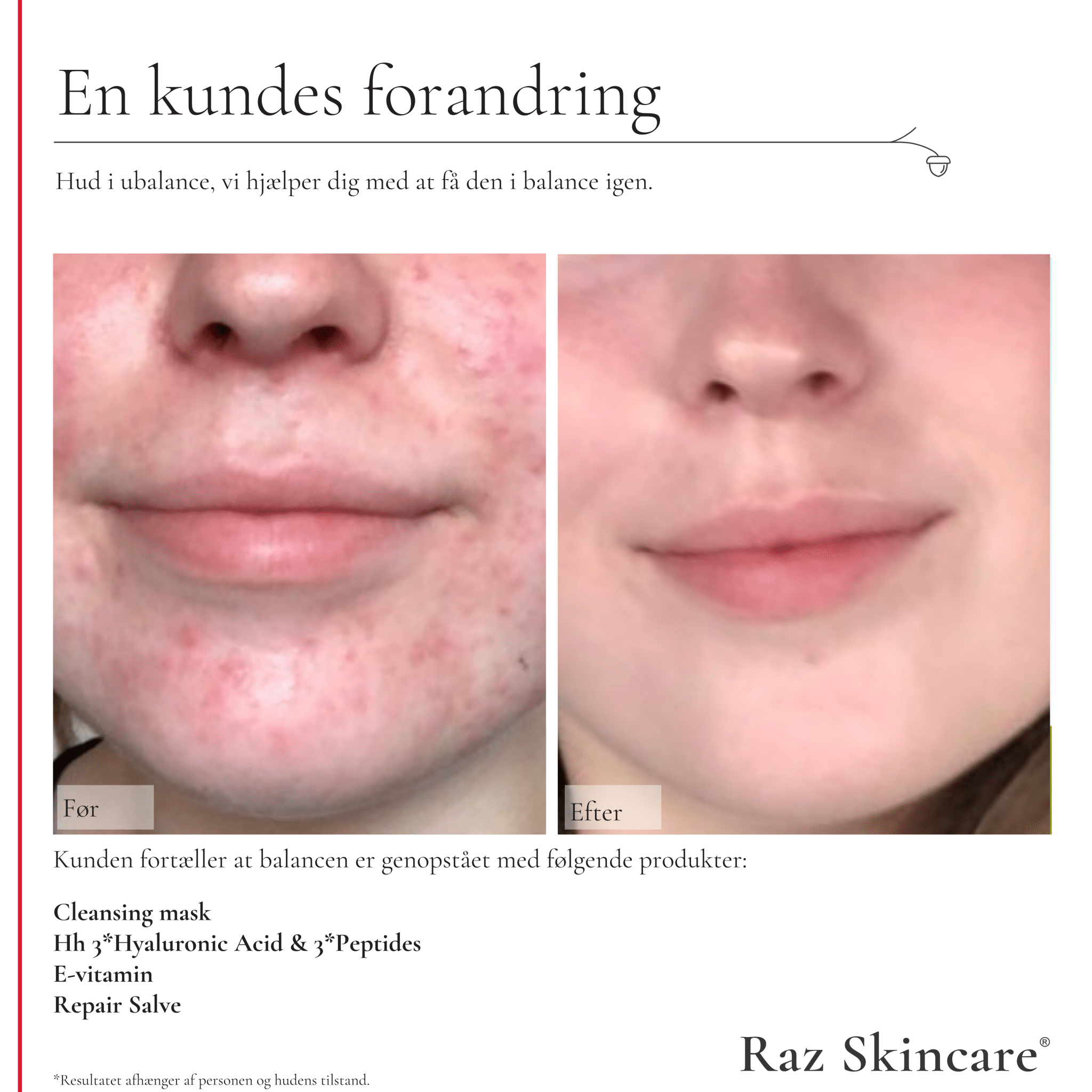 Cleansing Mask 200g - Raz Skincare - Før- og efterbillede af kunde med ubalanceret hud, der viser markant forbedring efter brug af Cleansing Mask, Hh, E-vitamein og Repair Salve