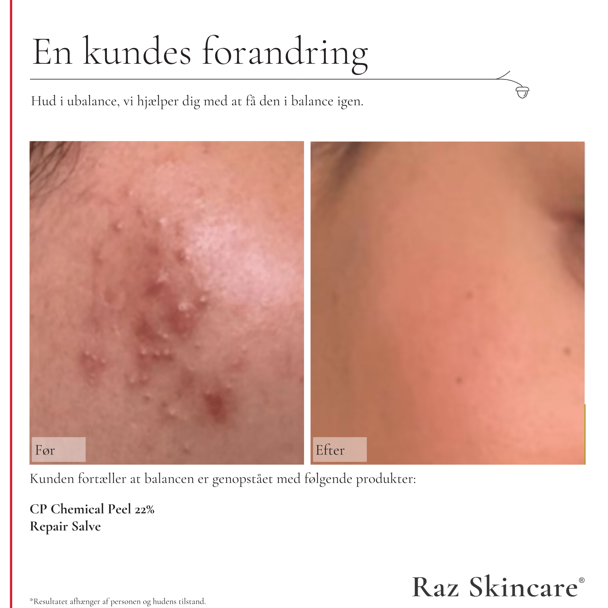 CP Chemical Peel 22% 30ml - Raz Skincare - Før- og efterbillede af kunde med hudirritation på kinden, der viser markant forbedring efter brug af Repair Salve og Cp Chemical Peel 22%
