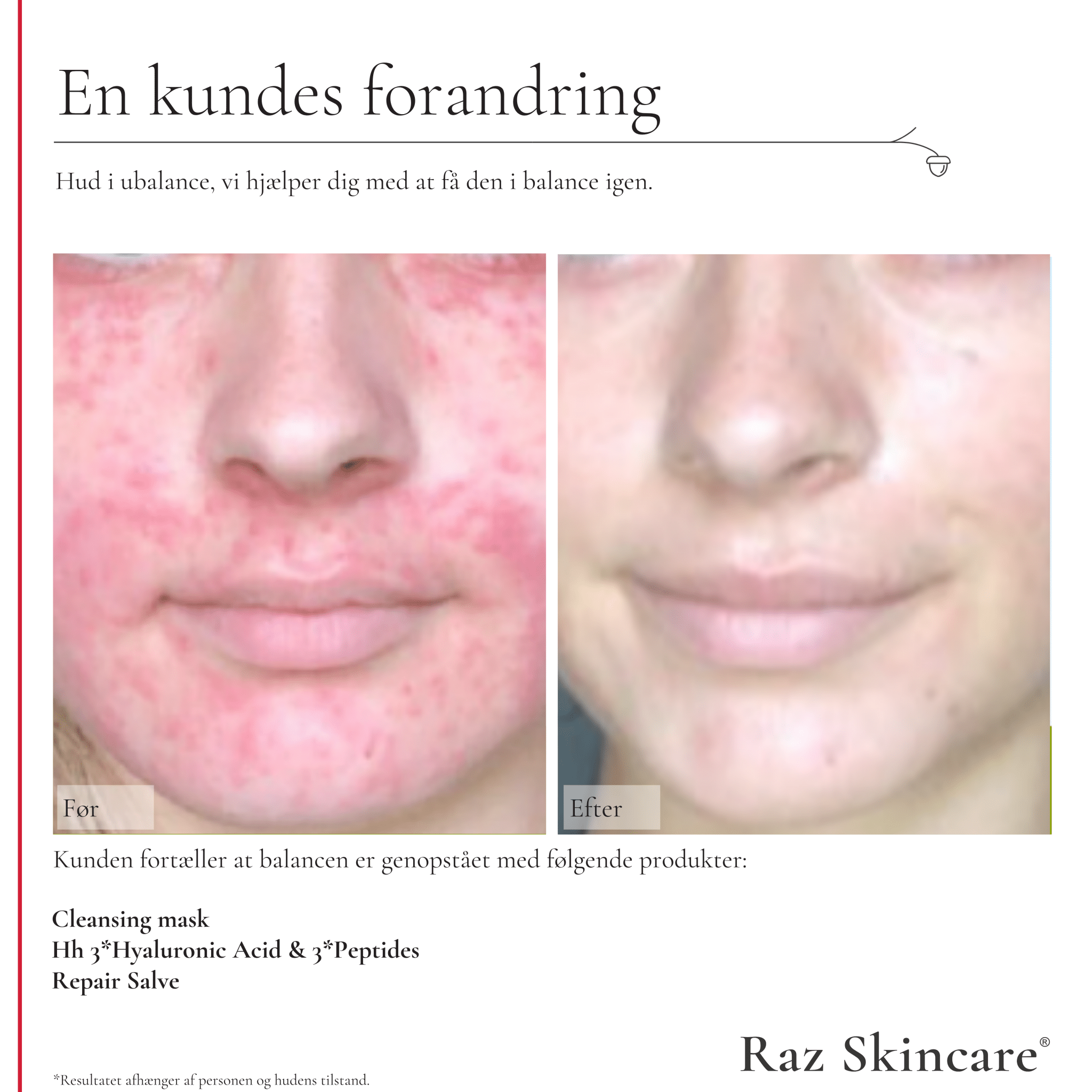 Hh 30ml - Raz Skincare - Før- og efterbillede af kunde med hudirritation, der viser markant forbedring efter brug af Cleansing Mask, Hh  og Repair Salve.