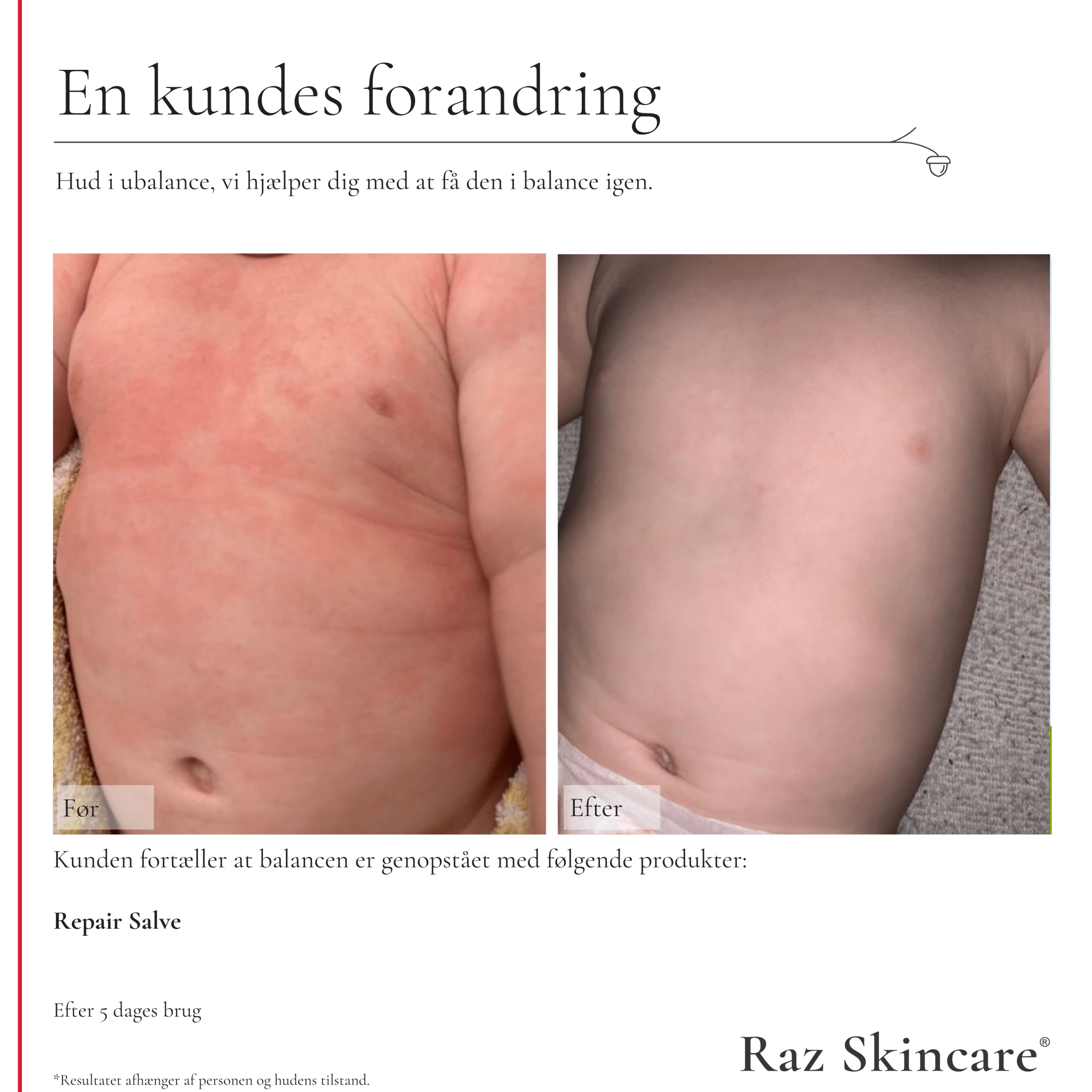 Børneeksem, repair salve før og efter billeder