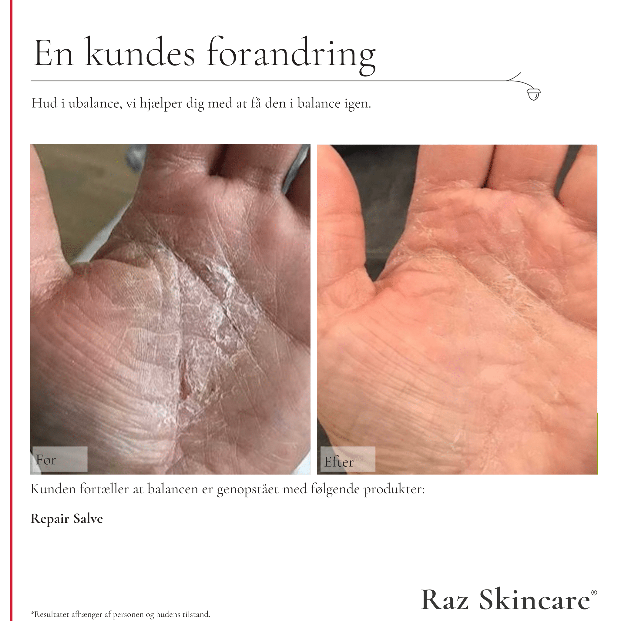 Repair Salve, Perfume free 100ml - Raz Skincare - Før- og efterbillede af hånd med tør, sprækket hud, der viser forbedring efter brug af Repair Salve