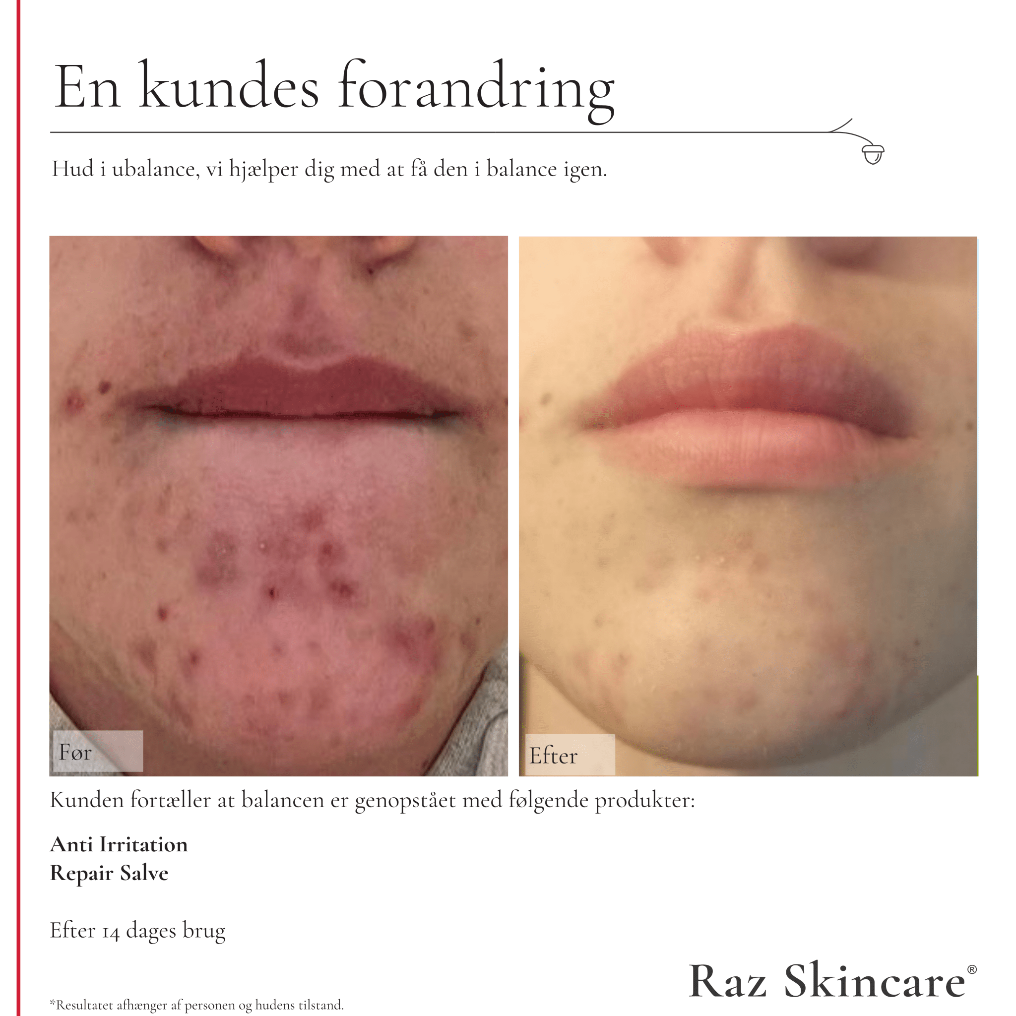 Repair Salve, Perfume free 100ml - Raz Skincare - 
ChatGPT sagde:
Før- og efterbillede af hageområde der i ubalance, der viser forbedring efter 14 dages brug af Anti Irritation og Repair Salve.