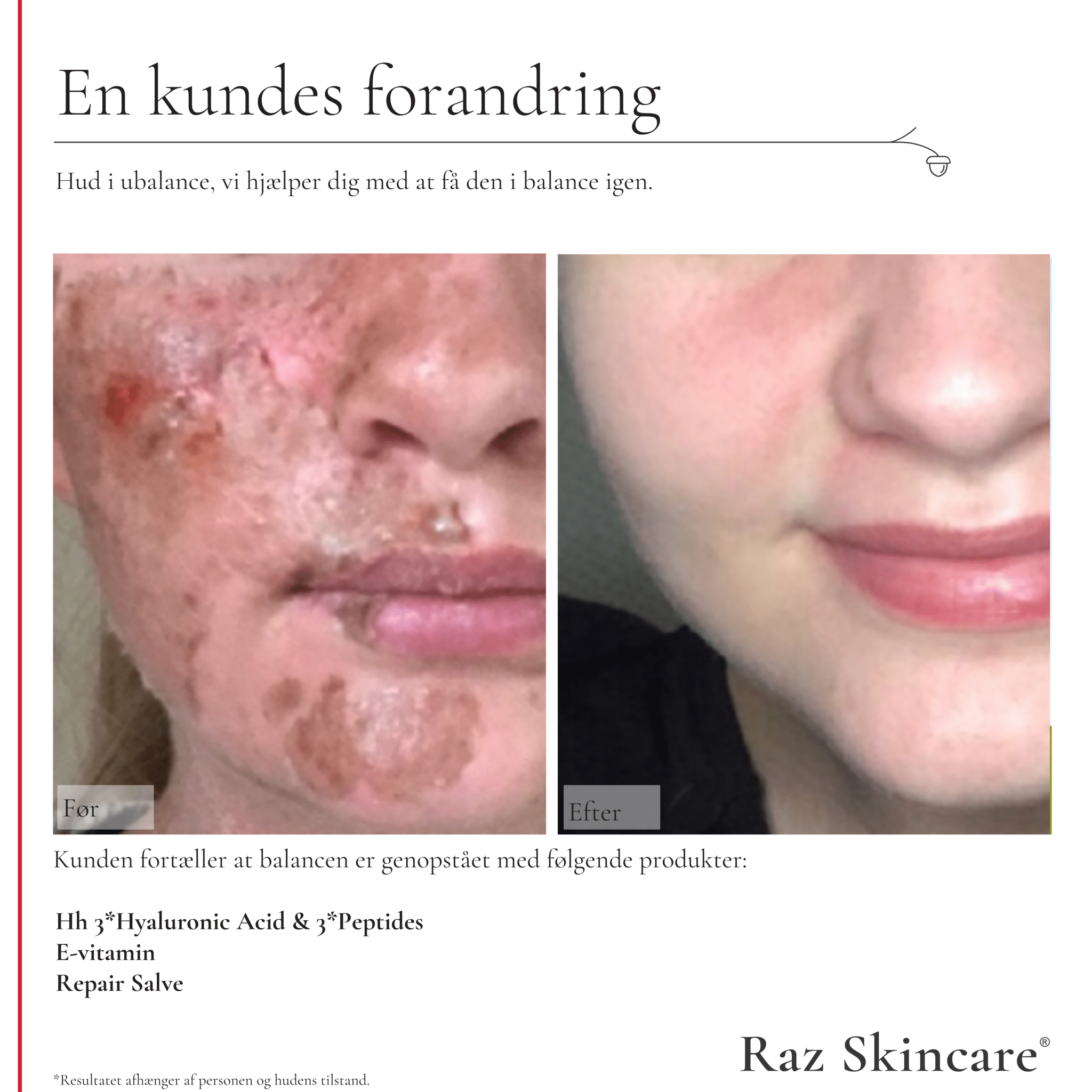 Repair Salve, Perfume free 15ml - Raz Skincare - Før- og efterbillede af ansigt i ubalance, der viser forbedring efter brug af Hh, E-vitamin og Repair Salve