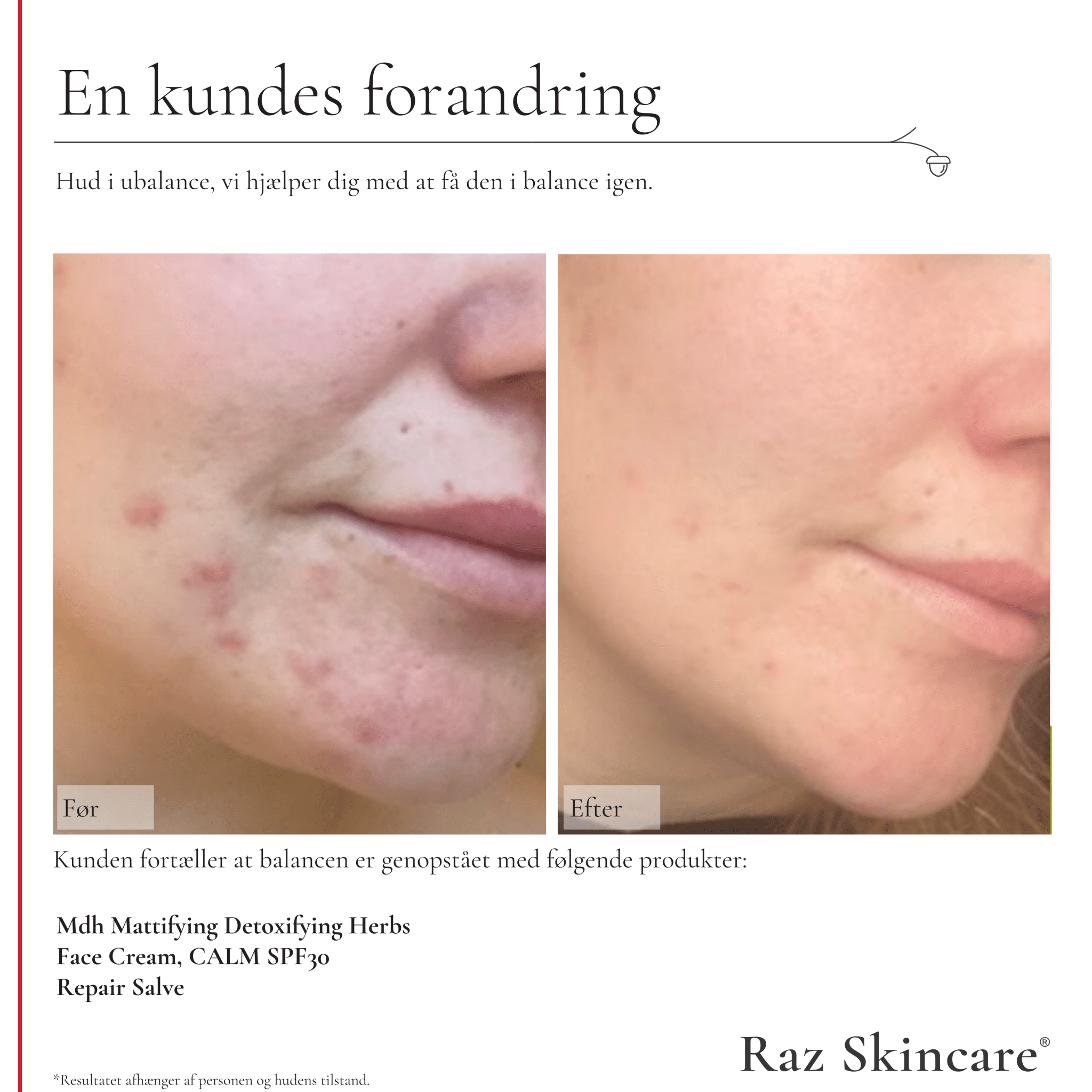 Repair Salve, Perfume free 15ml - Raz Skincare - Før- og efterbillede af mundområde der i ubalance, der viser forbedring efter brug af mdh, Calm Face Cream og Repair Salve