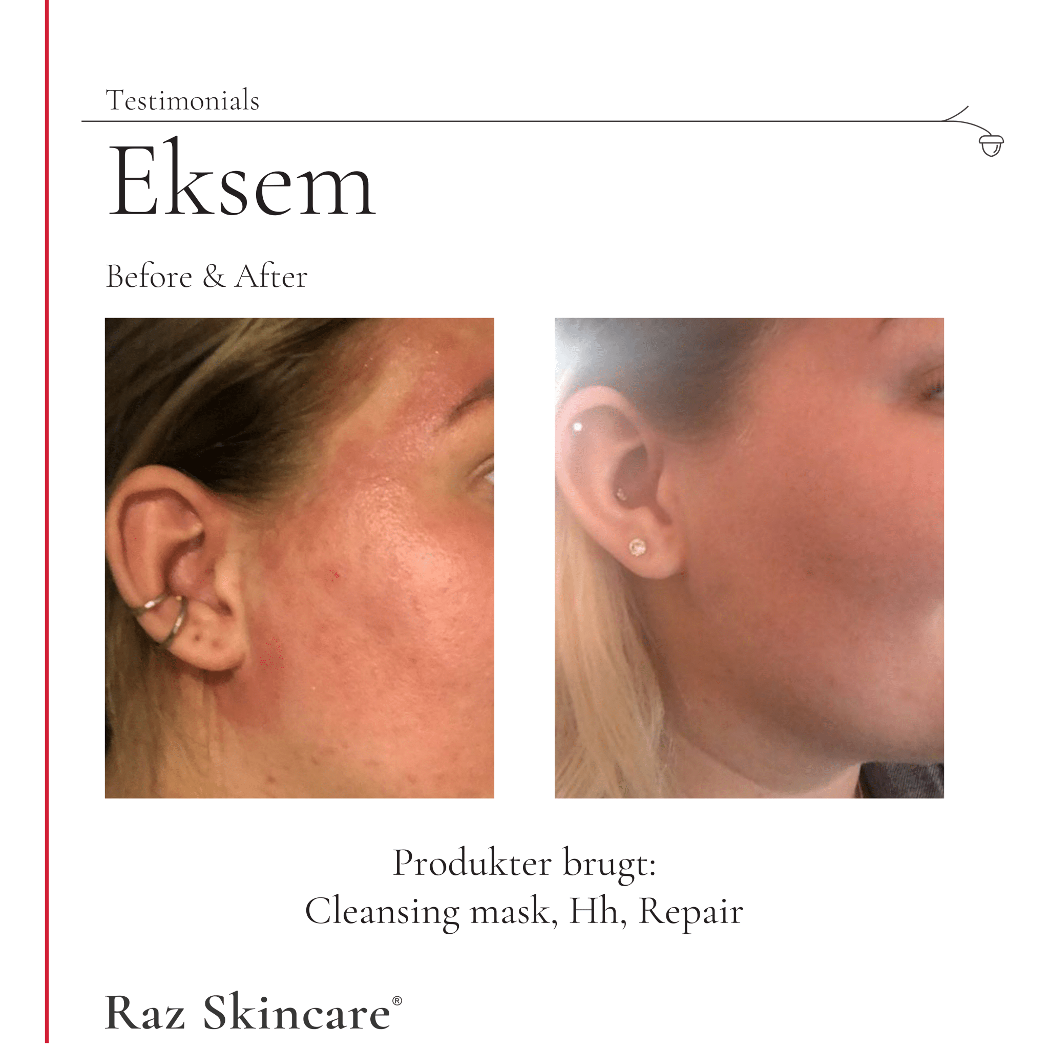 Et billede af en kunde med eksem, hvor man ser før og efter behandling, med Raz Skincare Repair, Hh og Cleansing Mask