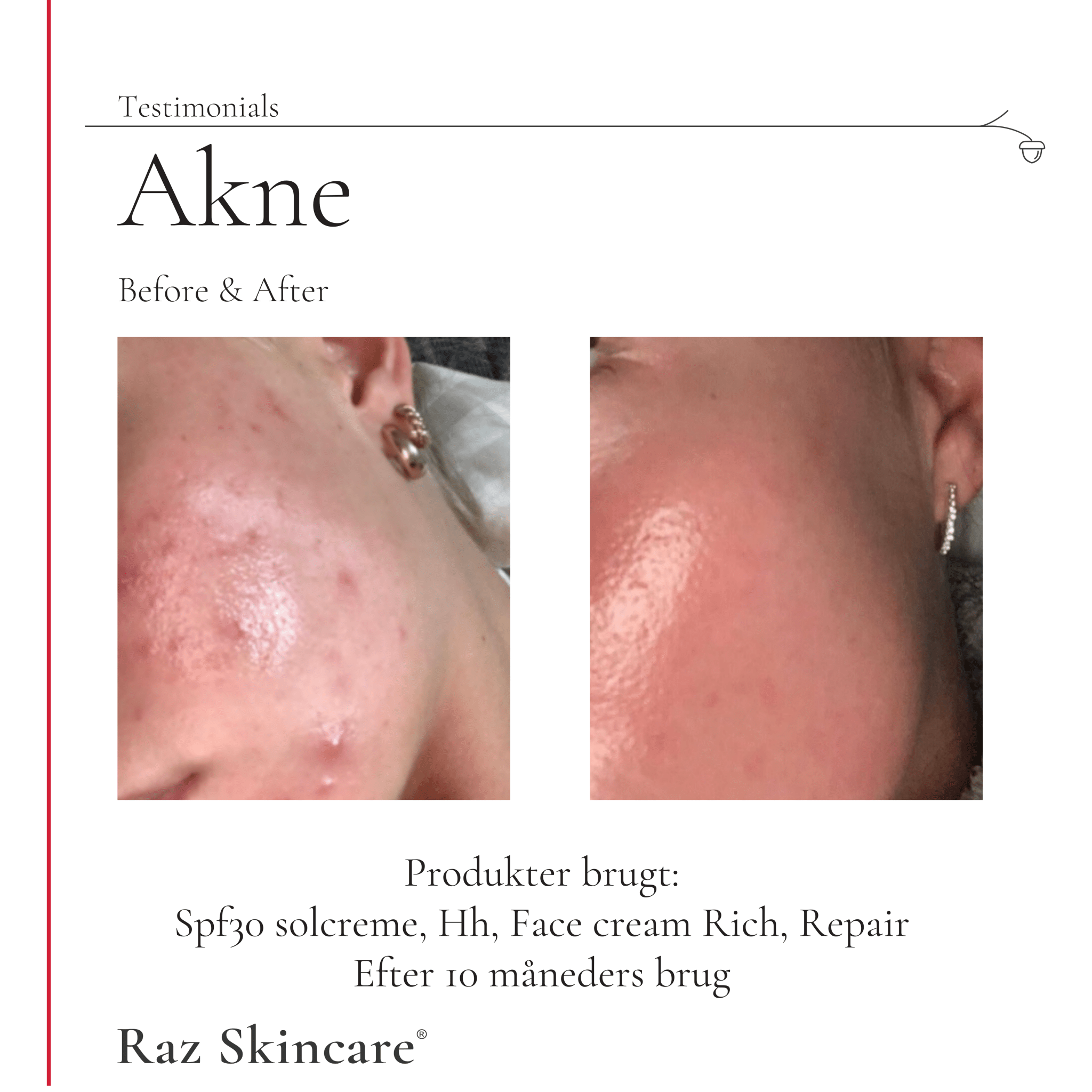 Før og efter billeder af en kundes kind med akne, ved brug af Repair SPF30, Hh og Rich. Venstre: Før Højre: Efter