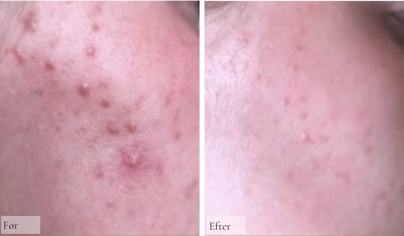 Derfor kan solcreme forværre akne, eksem og rosacea – og hvad du kan gøre ved det - Raz Skincare