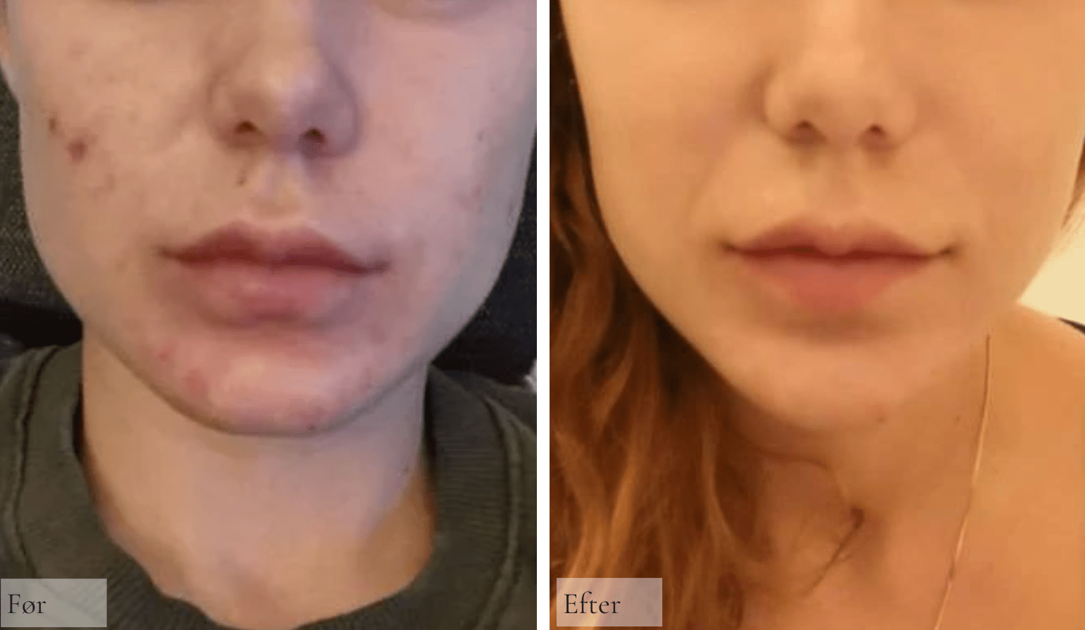 Hyperpigmentering / Pigmentpletter - Raz Skincare