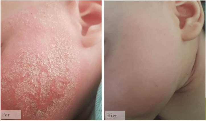 Mor & Baby:  Hudens forandringer før og efter fødslen - Raz Skincare