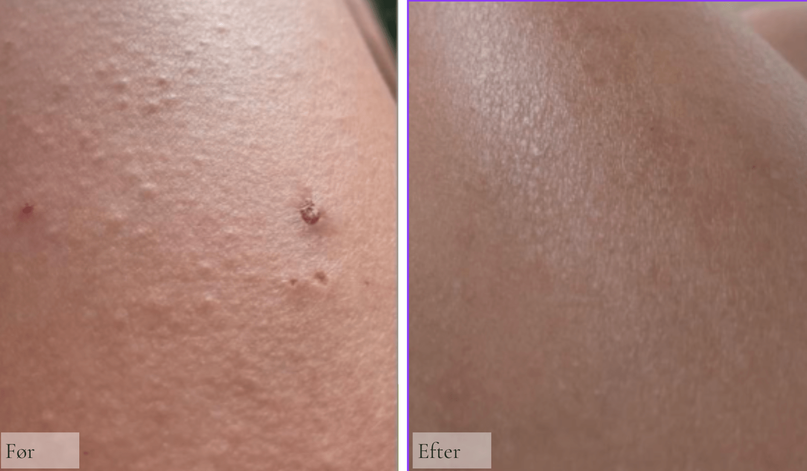 Raz Signaturbehandling mod Keratosis Pilaris og Jordbærben - Raz Skincare