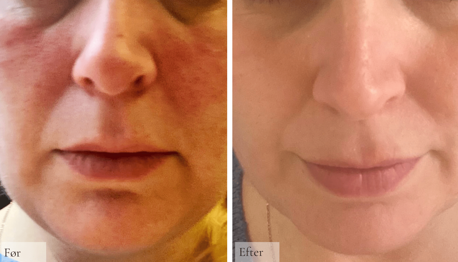 Rosacea - Raz Skincare