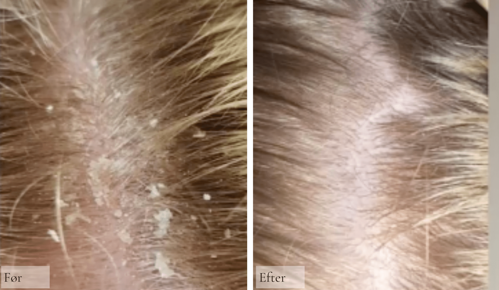 Skæl, eksem og psoriasis i hovedbund - Raz Skincare
