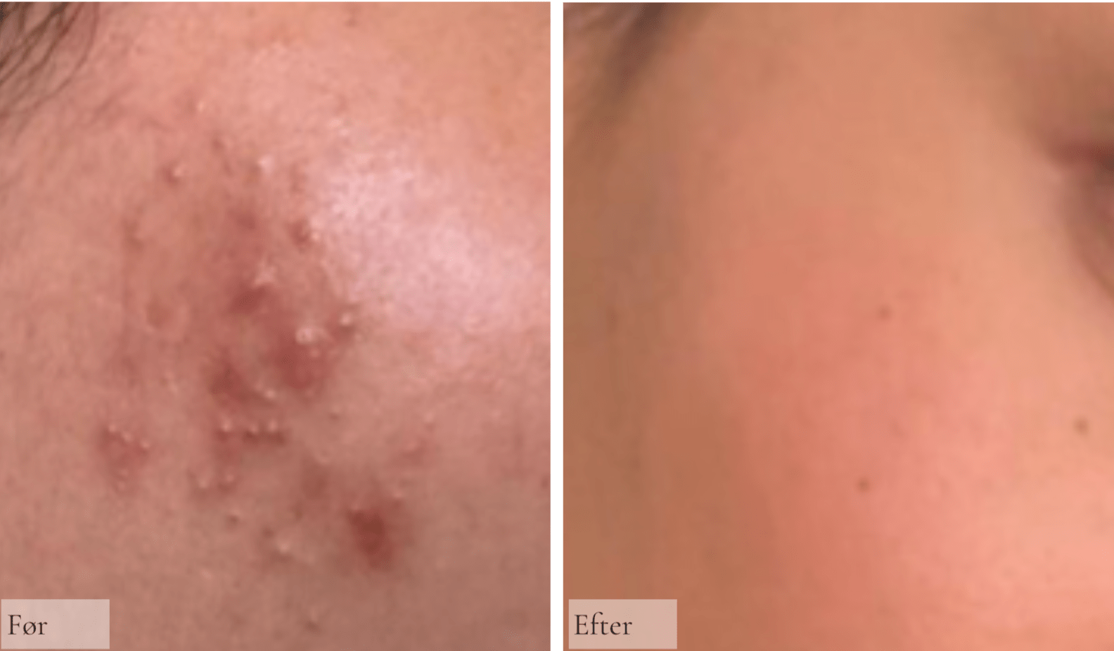 Talgknopper - Raz Skincare