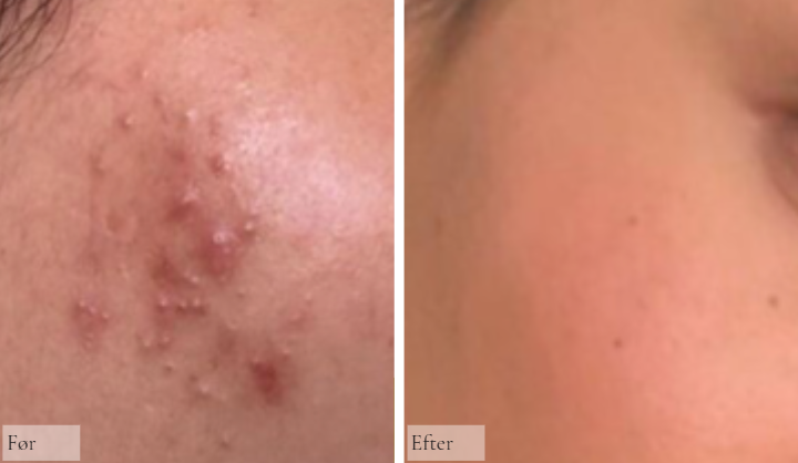 Sebaceous glands 