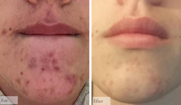 Akne/Perioral dermatitis