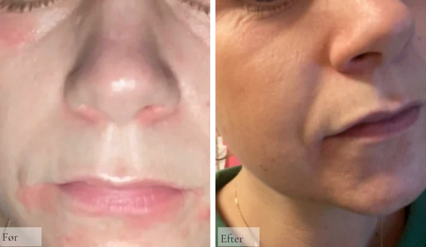 Eksem og Perioral dermatitis