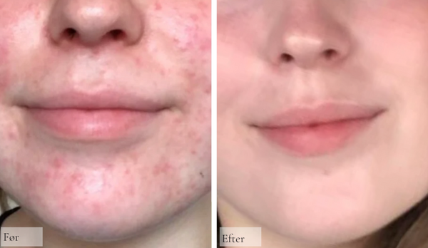 Perioral dermatitis