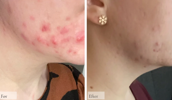 Akne og Perioral dermatitis