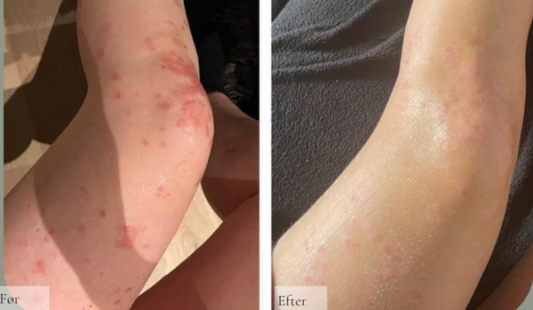Psoriasis på benene