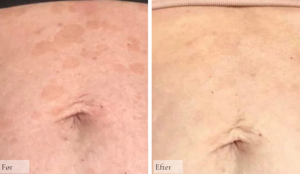 Psoriasis på maven