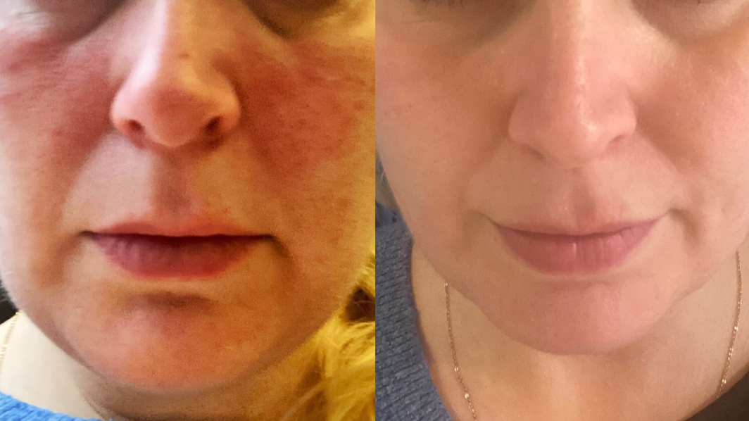 Rosacea