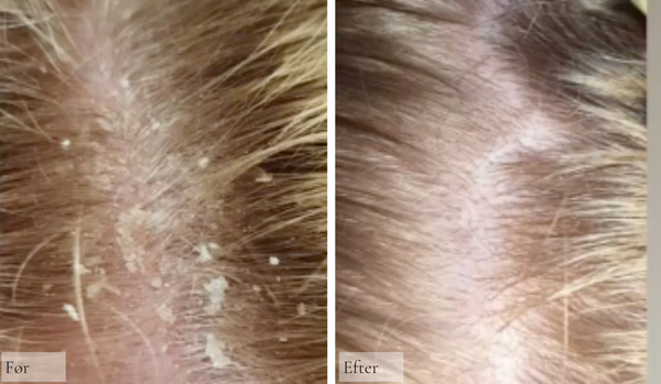 Psoriasis i hovedebunden