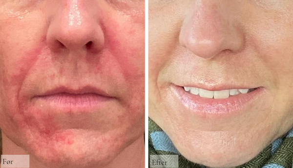 Perioral dermatitis