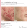 Før og efter billede af en kundes forandring ved hjælp af Raz Skincare A-retinoid 5% 30ml og 2 andre produkter