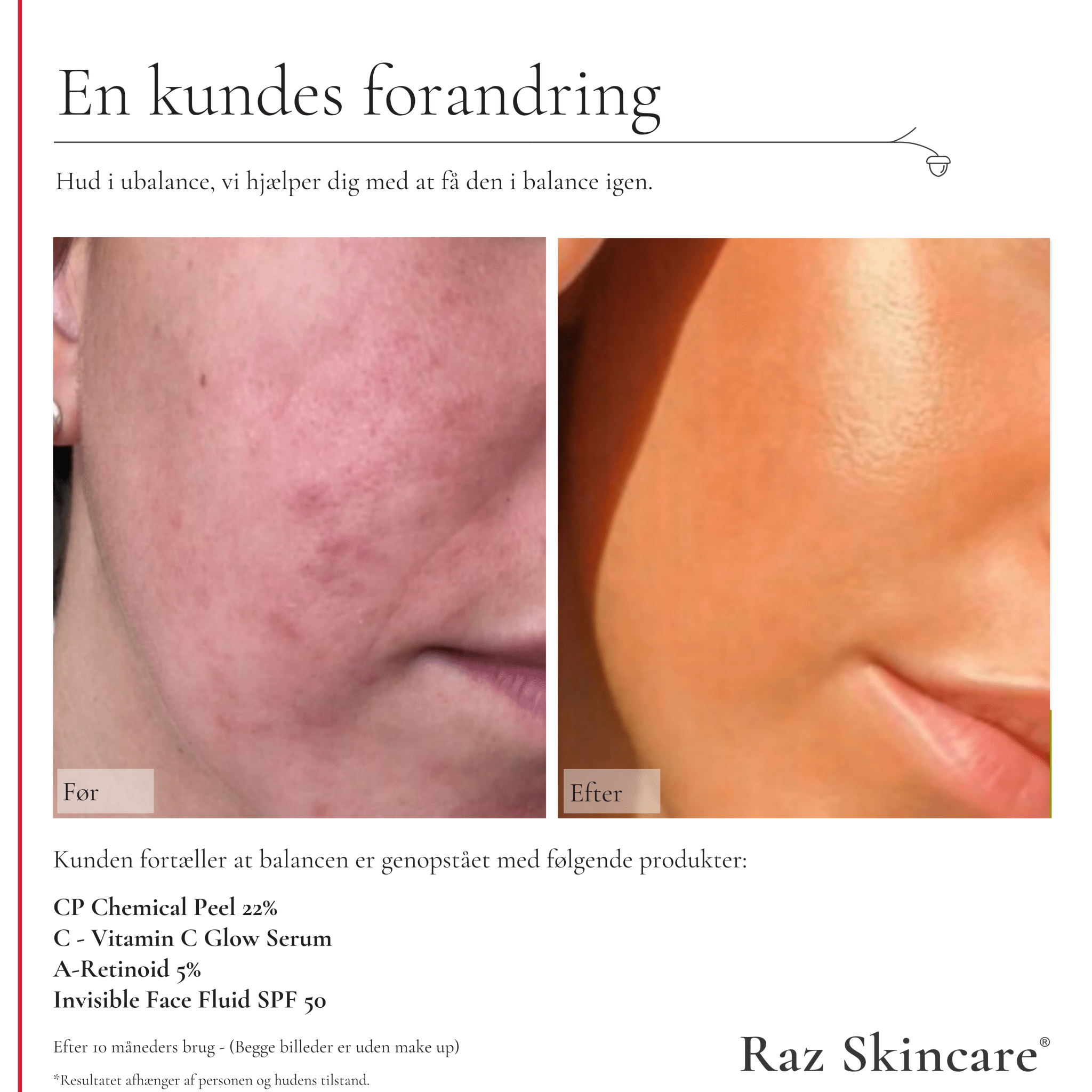 Før og efter billeder af en kundes forandring ved brug af Raz Skincare A-retinoid