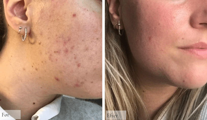 Akne Vulgaris/uren hud - Raz Skincare