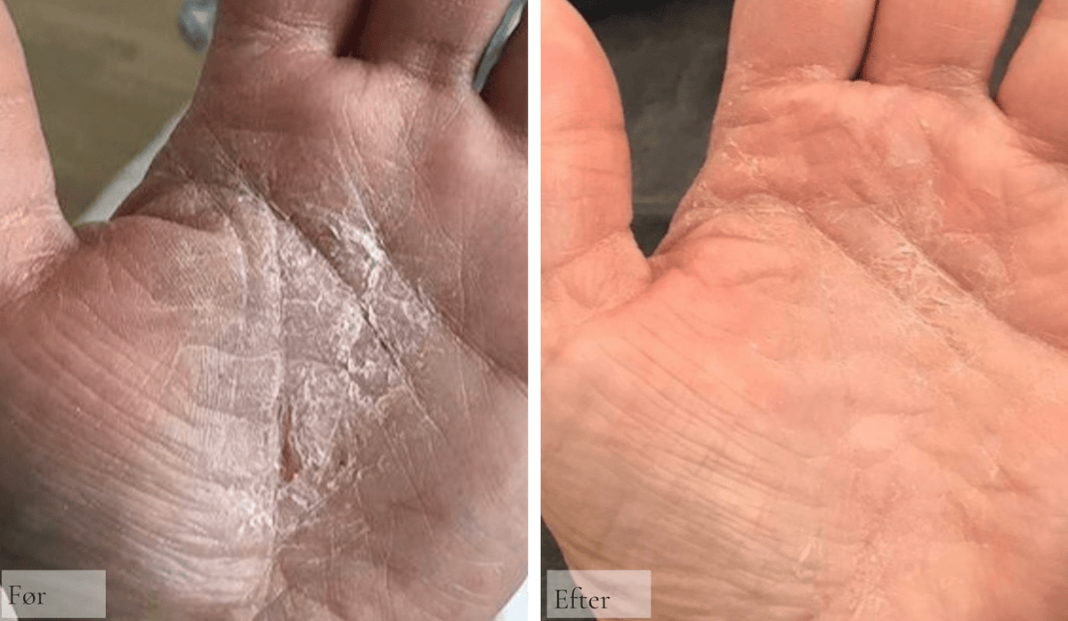 Håndeksem – tørre, revnede hænder - Raz Skincare