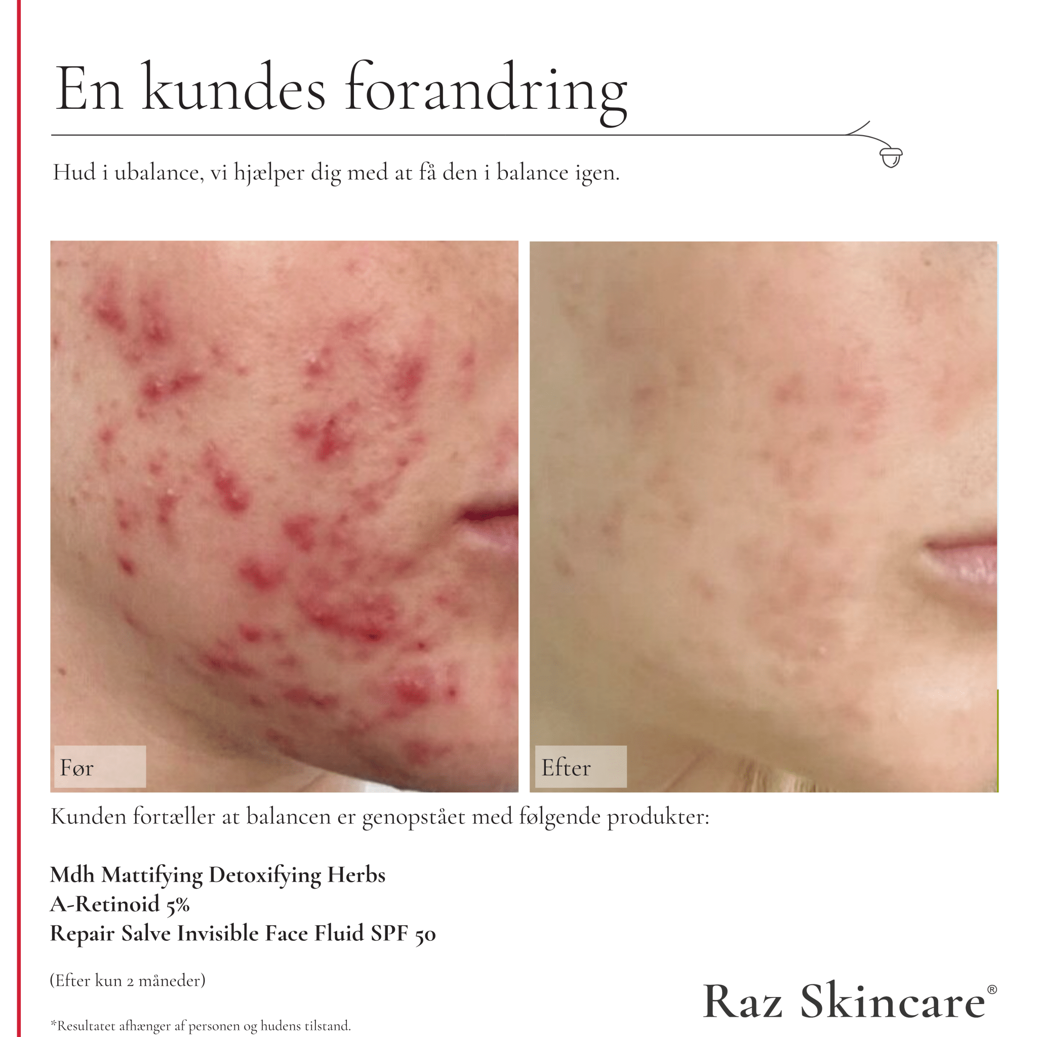 Mdh 30ml mod akne, med før og efter billeder af problemet