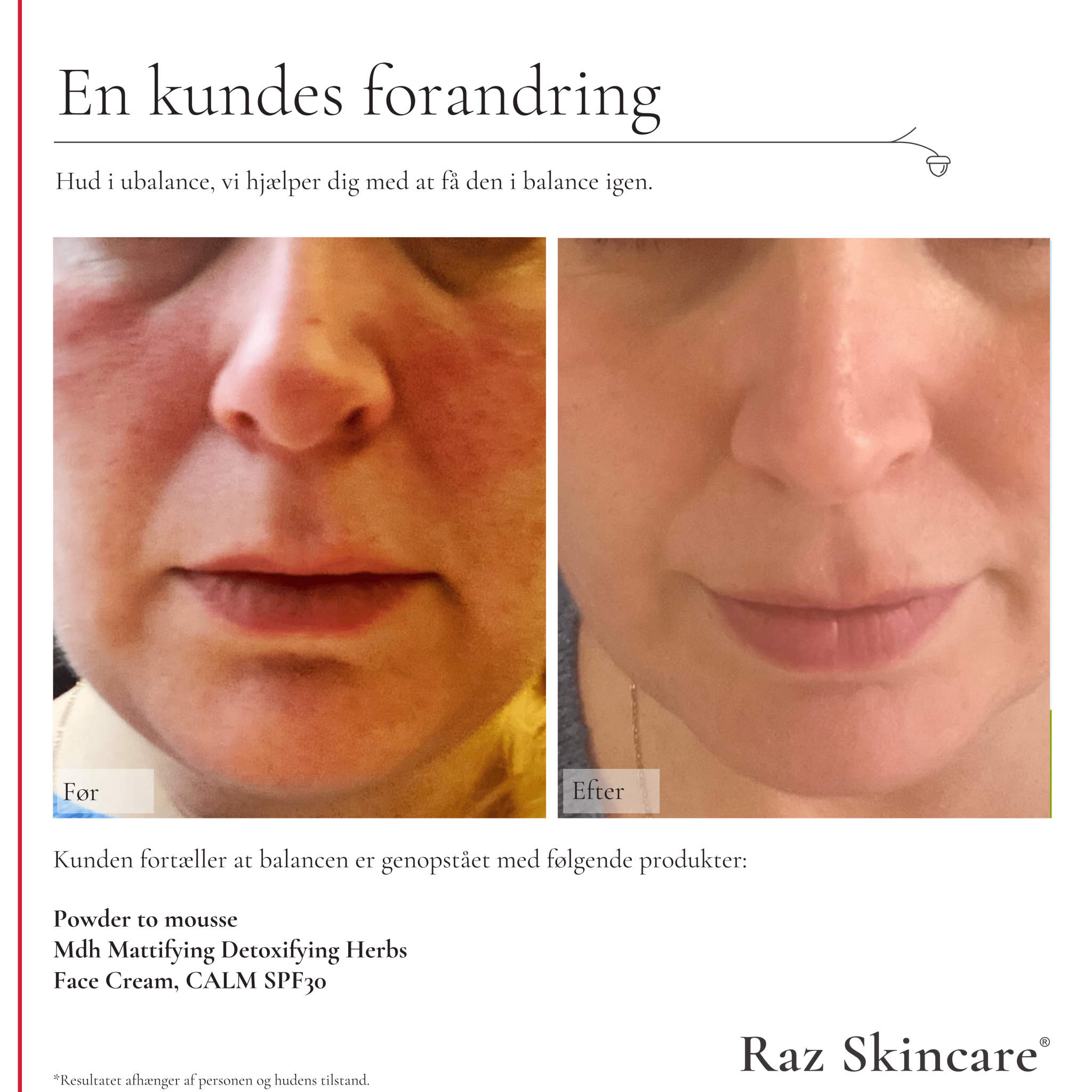 Før og efter billeder af urenheder, ved brug af mdh 30ml