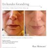 Før og efter billeder af urenheder, ved brug af mdh 30ml