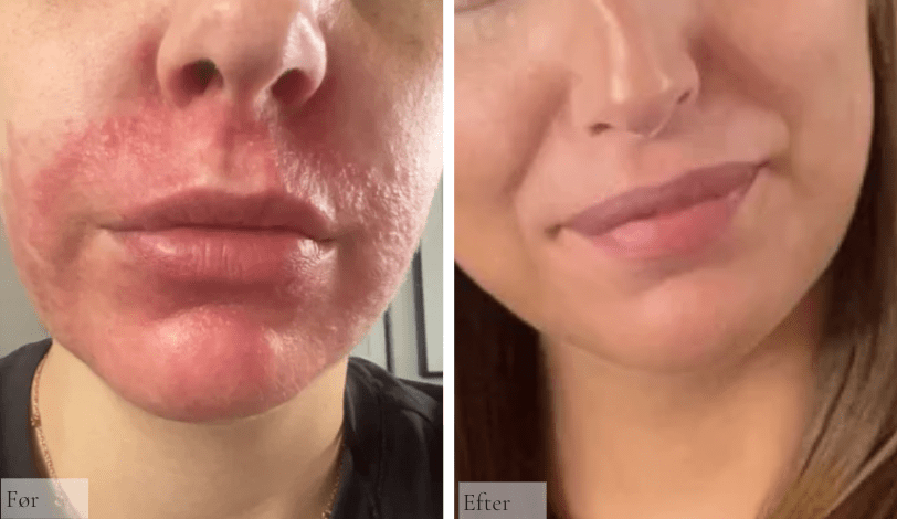 Perioral Dermatitis - Raz Skincare
