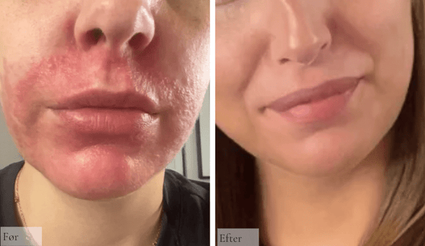 Perioral dermatitis 