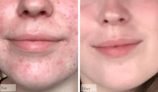 Perioral dermatitis