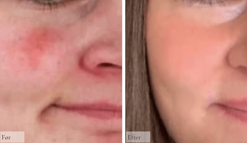 Rosacea - Raz Skincare