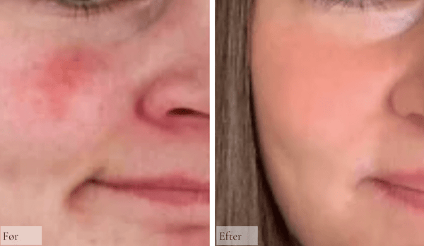 Rosacea