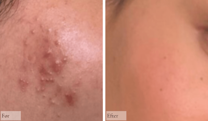 Talgknopper - Raz Skincare